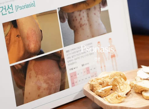 생기한의원으로 확인하는 건선과 지루성피부염 비교 정보